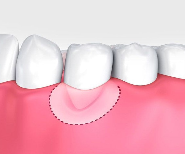 Illustration of gum graft