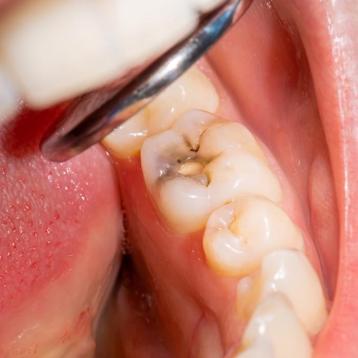 Decayed Tooth