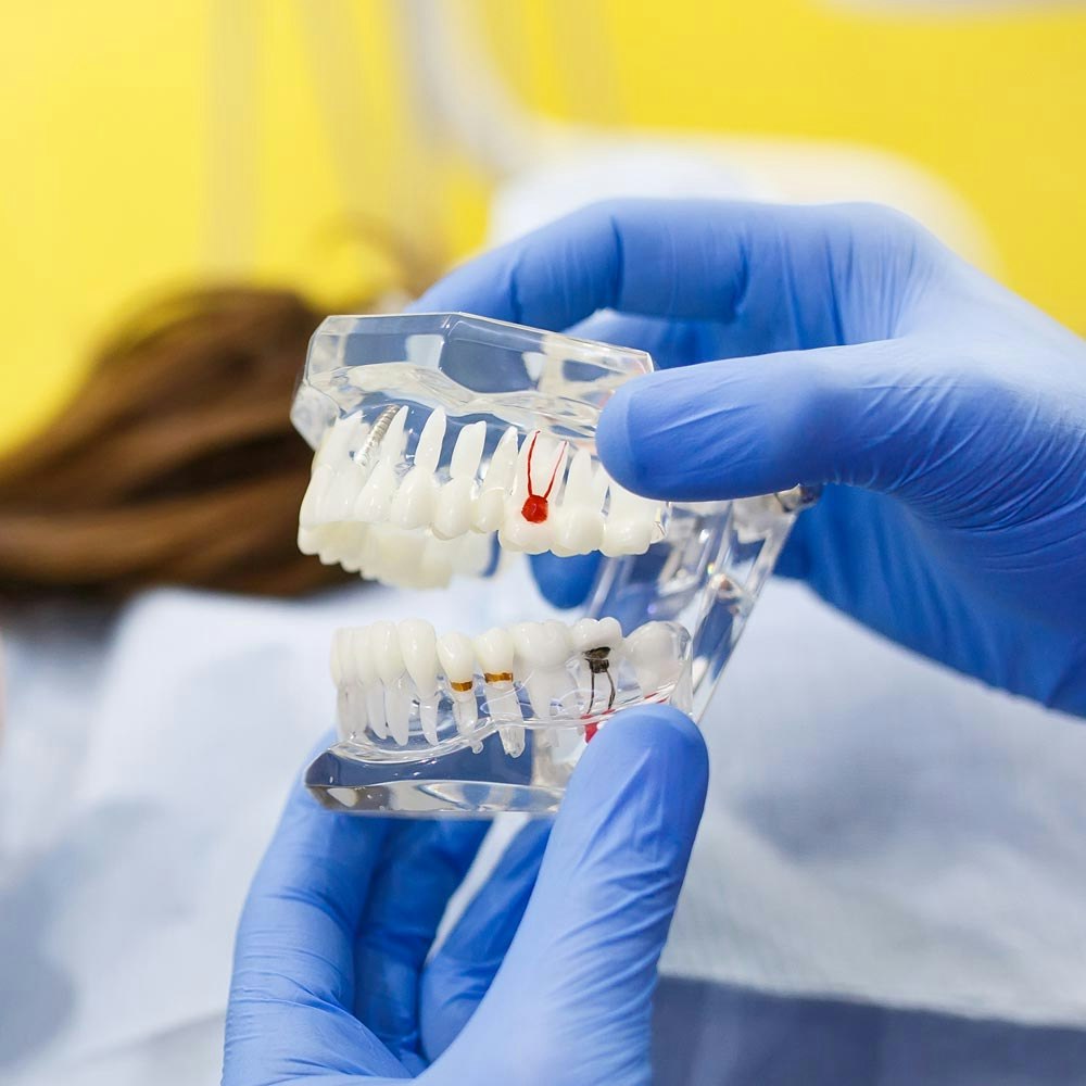 Illustration of infected root canal