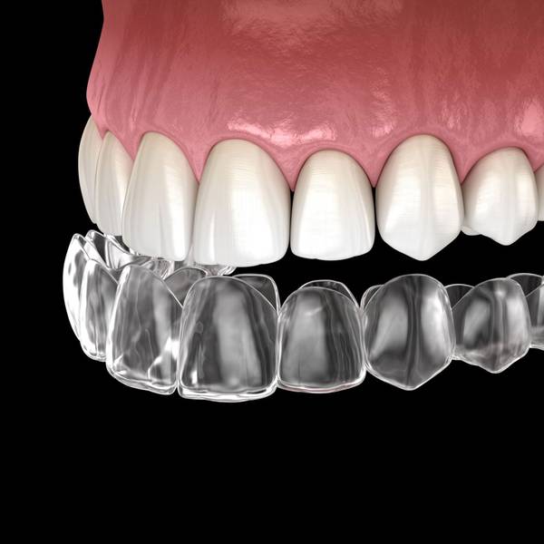 Invisalign aligner tray